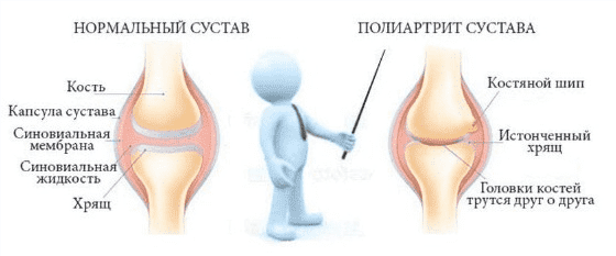 Скачать - Игорь Кауфман. Реаматоидный полиартрит (2022).png